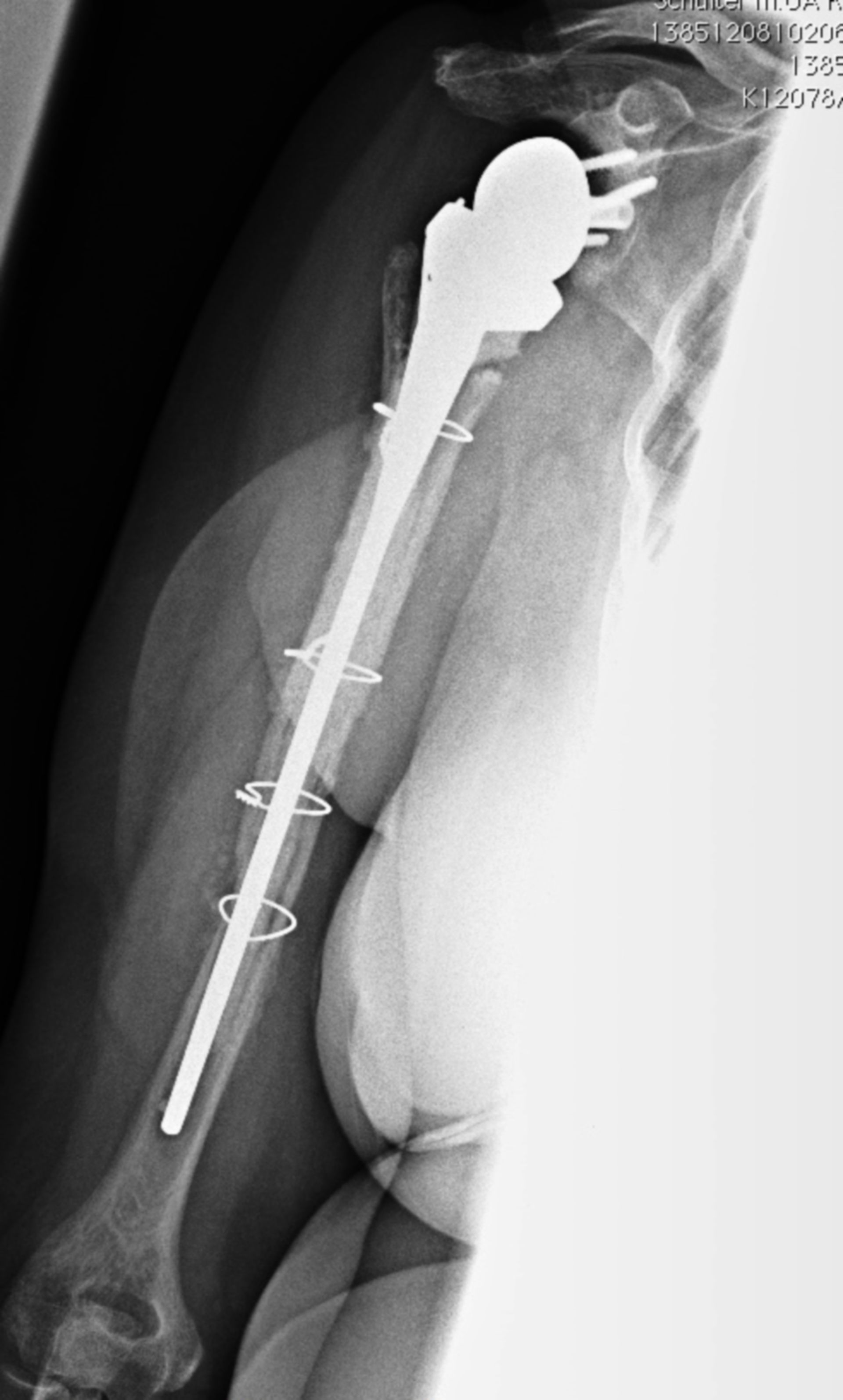 Endo-Model® Shoulder Prosthesis