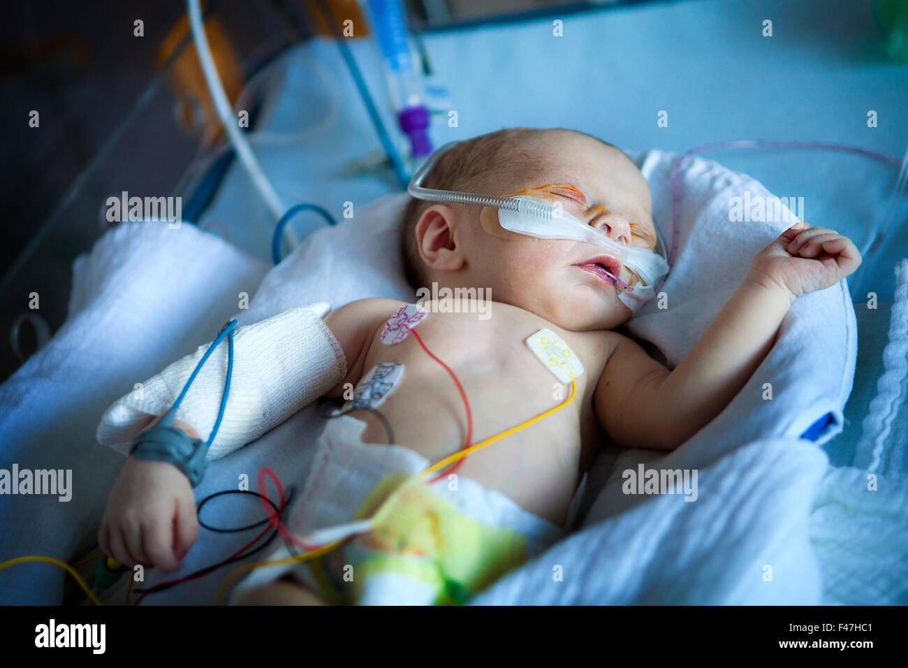 NASAL CANNULA 13320 PREMATURE