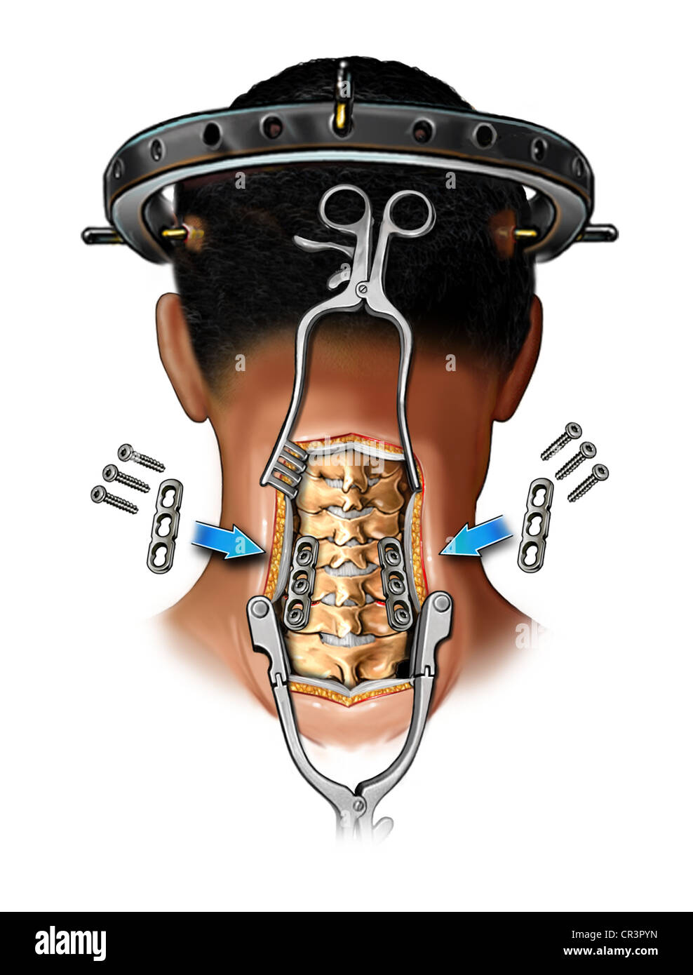 PLATE 6190057 ANTERIOR CERVICAL 57.5MM
