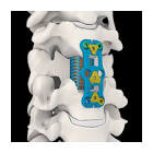 PLATE 6190075 ANTERIOR CERVICAL 75MM