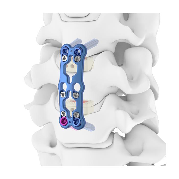 PLATE 6190085 ANTERIOR CERVICAL 85MM