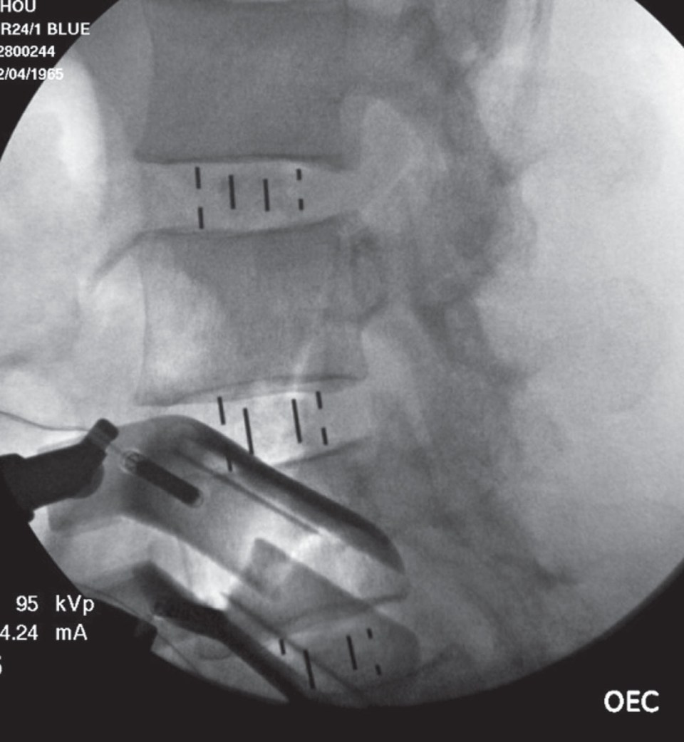 INSTRUMENT SET, 9731426 NAVIGATED LUMBAR