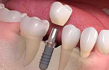 IMPLANT 4210764 STANDALONE 16 X 14 X 7MM