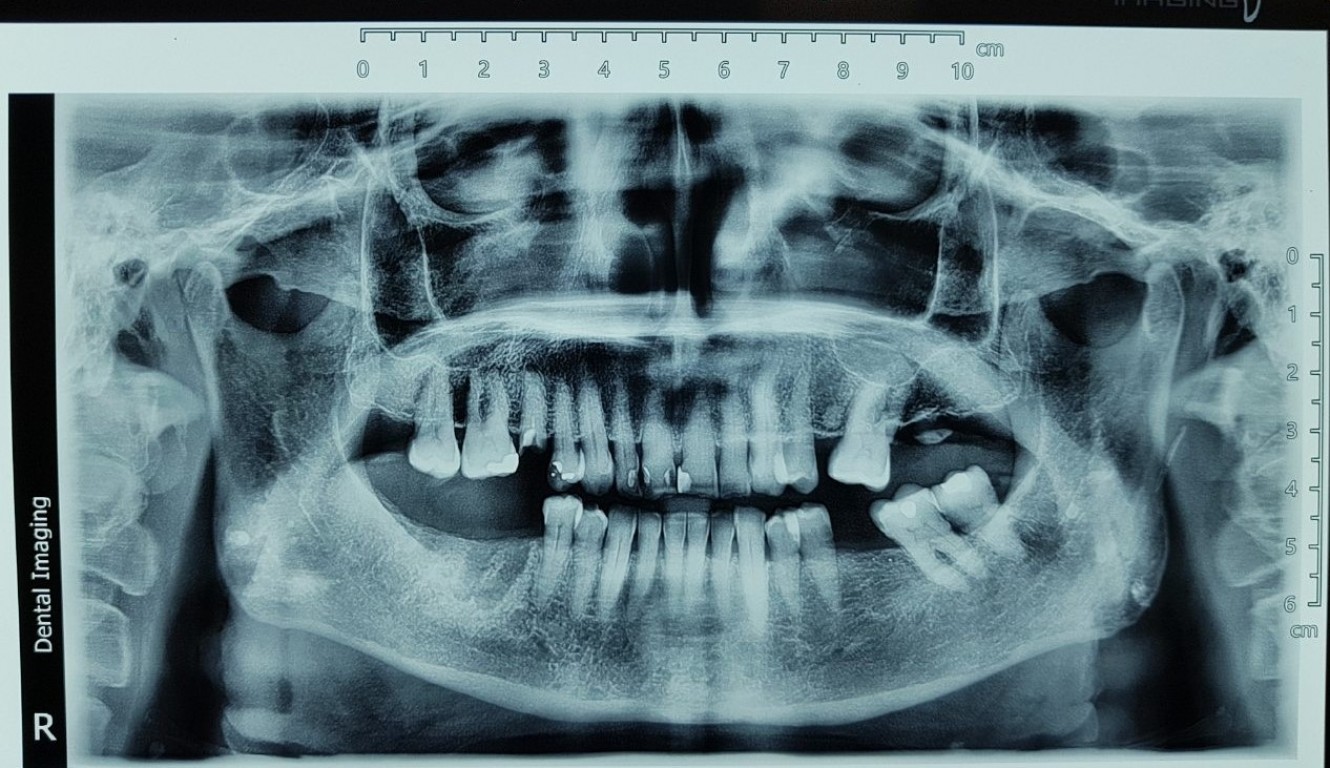SUITCASE 23000000 IMPLANT
