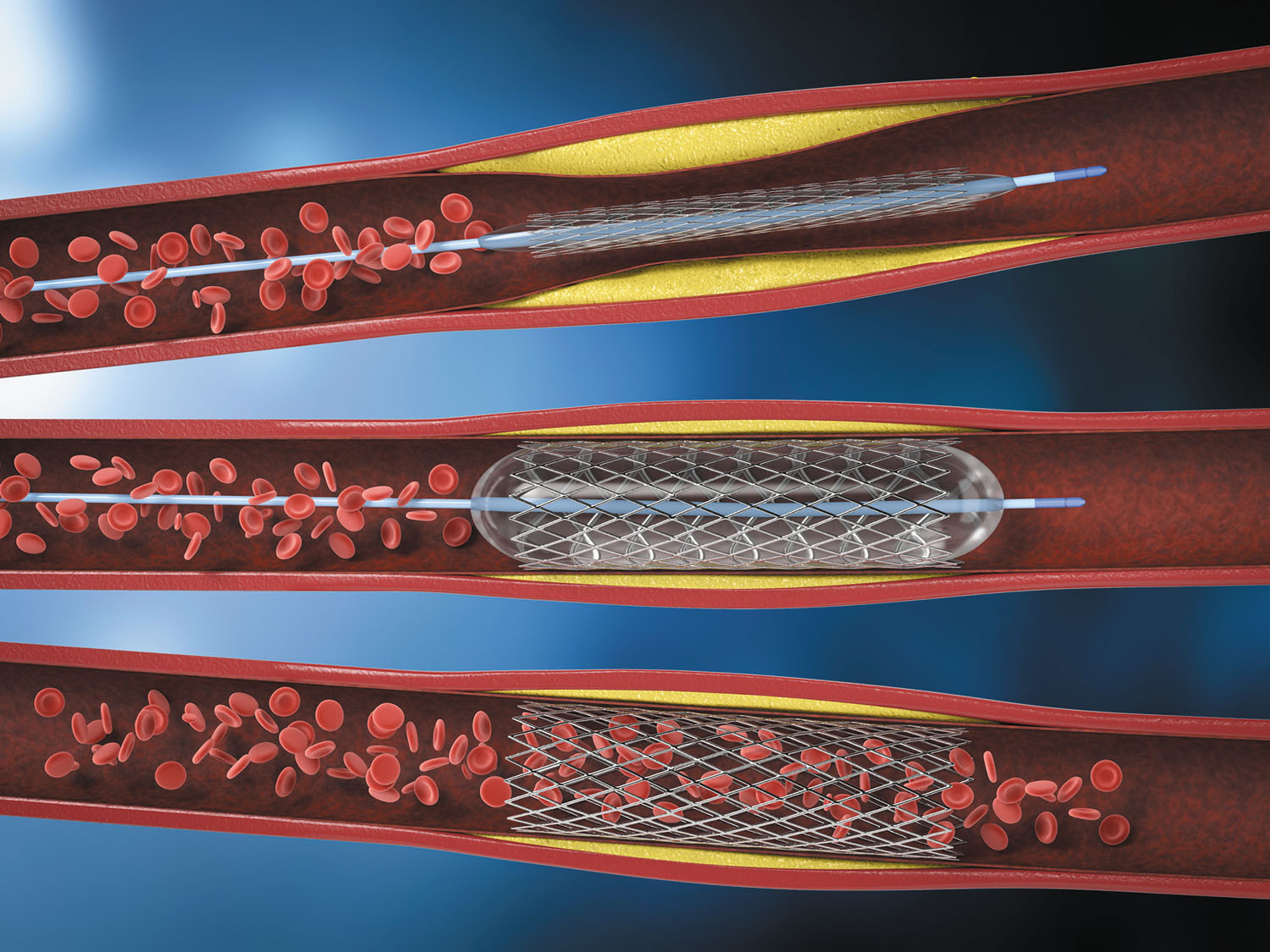 STENT GRAFT VAMF2222C150TE CAPTIVIA