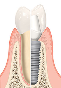 TRAY 1855125 CDHS MAS IMPLANTS EU