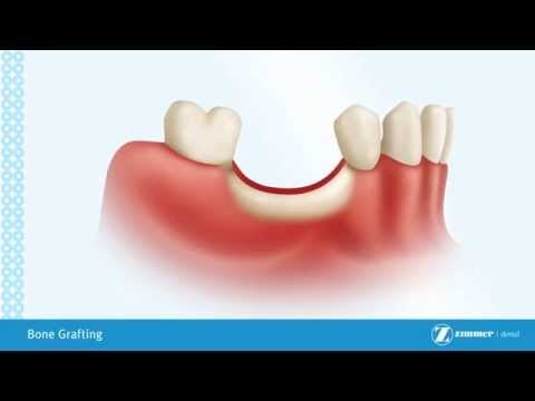 BONE GRAFT 7509215INT MG 1 CM X 5 CM