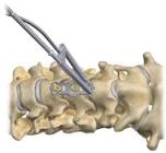 PIN 3030003 ZEVO PLATE HOLDING PIN