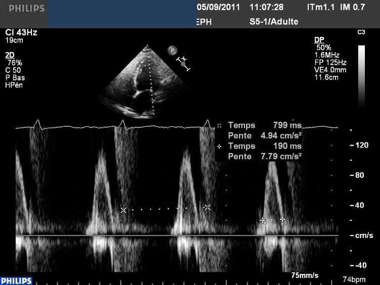 MHV 500DM31 STD MITRAL