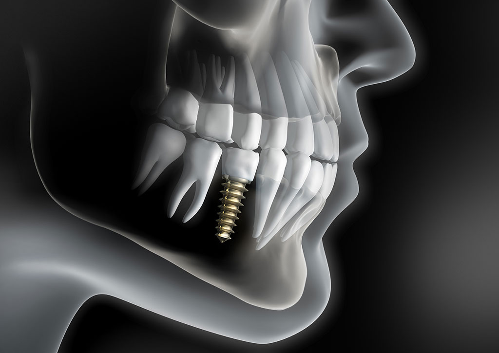 CASE 165-322 3D TI IMPLANT TRAY LID