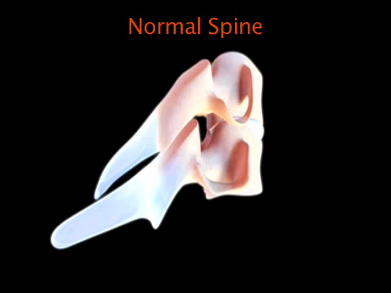 MOTION 6971270 CERVICAL DISC 7MMX12MM