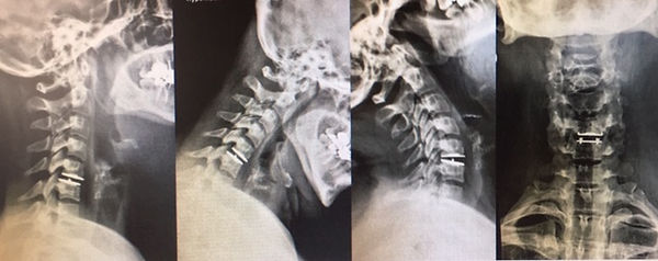 MOTION 6971480 CERVICAL DISC 8MMX14MM