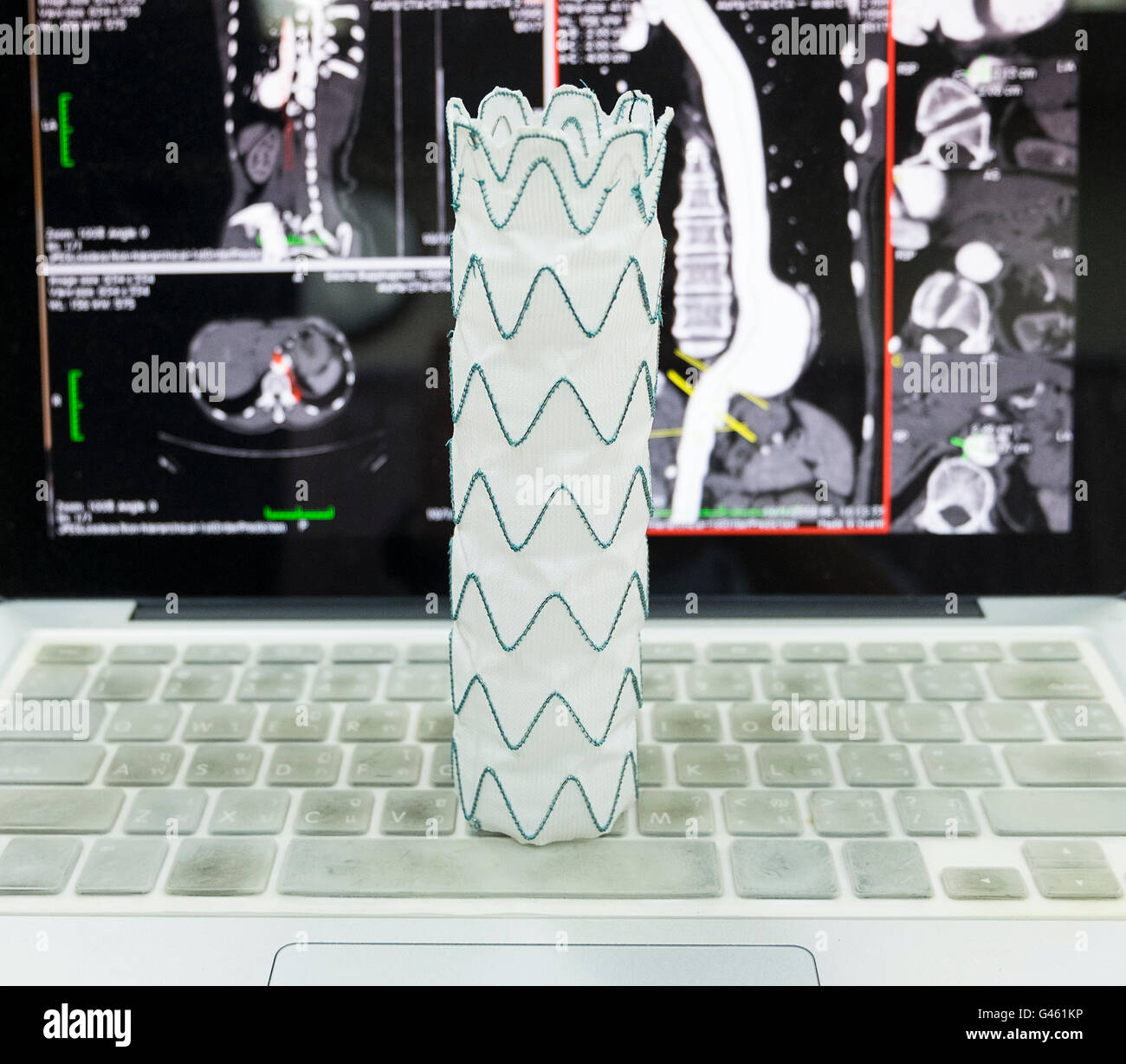 STENT GRAFT ETCF2525C49EE ENDUR II CUFF