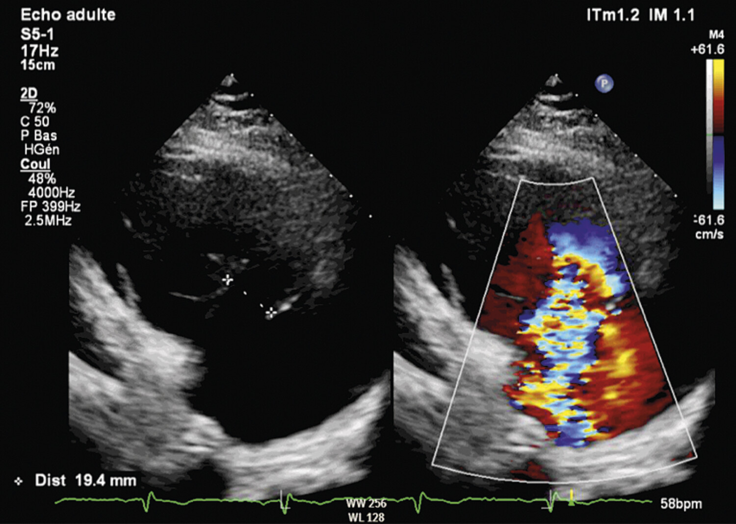 BAND 900SFC236 TRI-AD2.0 ADAMS TRICUSPID