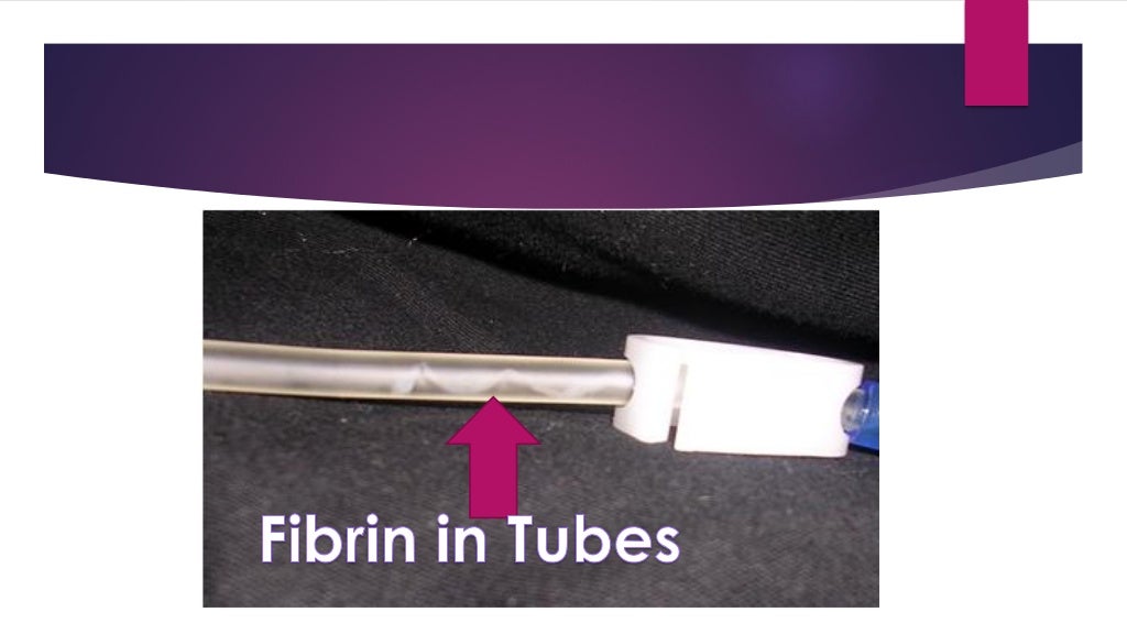 Updike Spiral Chronic Peritoneal Dialysis Catheter Tray, 1 Tray