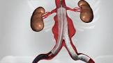 Zenith Aaa Endovascular Graft Aaa Ancillary Component Iliac Leg Extension, 1 Each