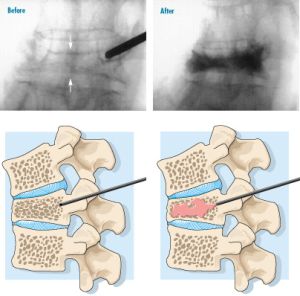 Osteo-site Vertebroplasty Needle Holder, 1 Each