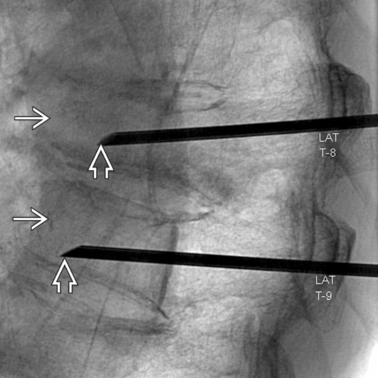 Osteo-site Vertebroplasty Needle Holder, 1 Each