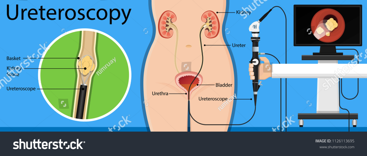 Ureteroscopy Irrigation System, 1 Each