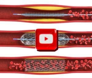 Stent Introducer Set, 1 Set
