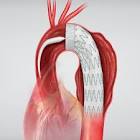 Zenith® Tx2® Taa Endovascular Graft Proximal Tapered Component, 1 Each