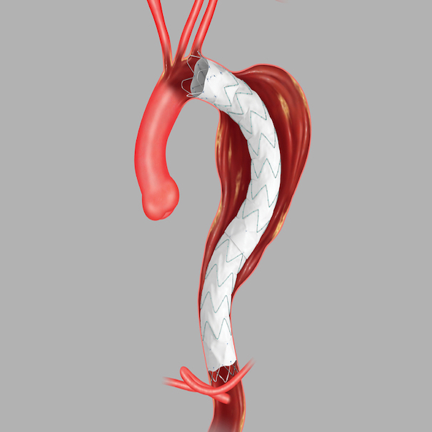 Zenith® Tx2® Taa Endovascular Graft Proximal Tapered Component, 1 Each