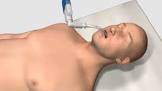 Cook Staged Extubation Set, 1 Set