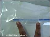Wilson-cook Achalasia Balloon, 1 Each