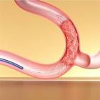 Nsnare Stent Retriever, 1 Each