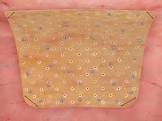 Biodesign 8-layer Tissue Graft, 1 Each