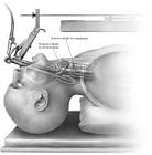 Zenker's Diverticulum Overtube, 1 Each