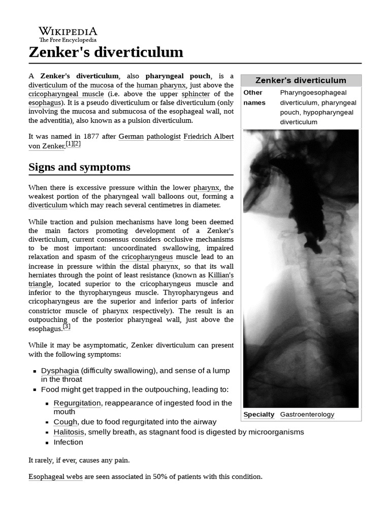 Zenker's Diverticulum Overtube, 1 Each