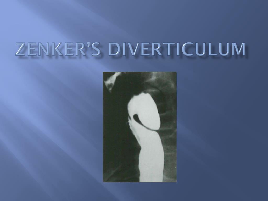 Zenker's Diverticulum Overtube, 1 Each