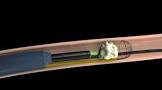 Ntrap Stone Entrapment And Extraction Device, 1 Each