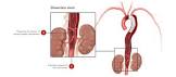 Zenith® Dissection Endovascular Stent, 1 Each