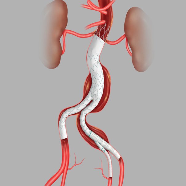 Zenith Alpha Abdominal Endovascular Graft, 1 Each