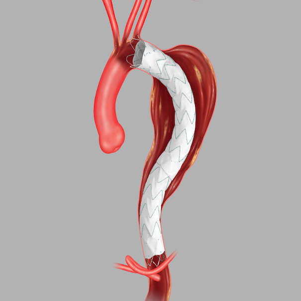Zenith Alpha™ Thoracic Endovascular Graft Proximal Tapered Components, 1 Each