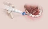 Sialocath™ Salivary Duct Catheter, 1 Each