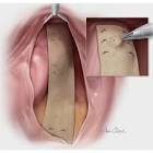 Biodesign ® Rectopexy Graft, 1 Each