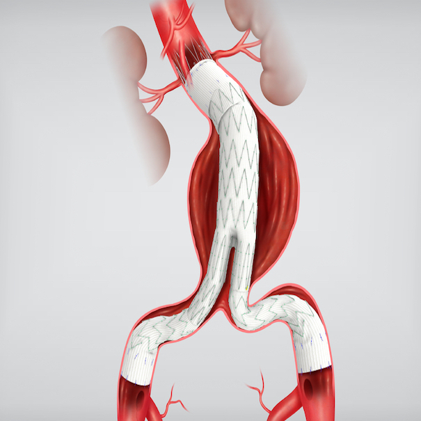 Zenith Aaa Endovascular Graft Iliac, 1 Each