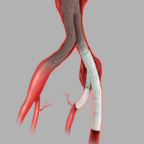 Bifurcated Iliac Sidebranch Endovascular Graft, 1 Each