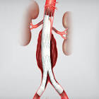 Zenith Fenestrated Aaa Endovascular Graft Distal Bifurcated Body, 1 Each