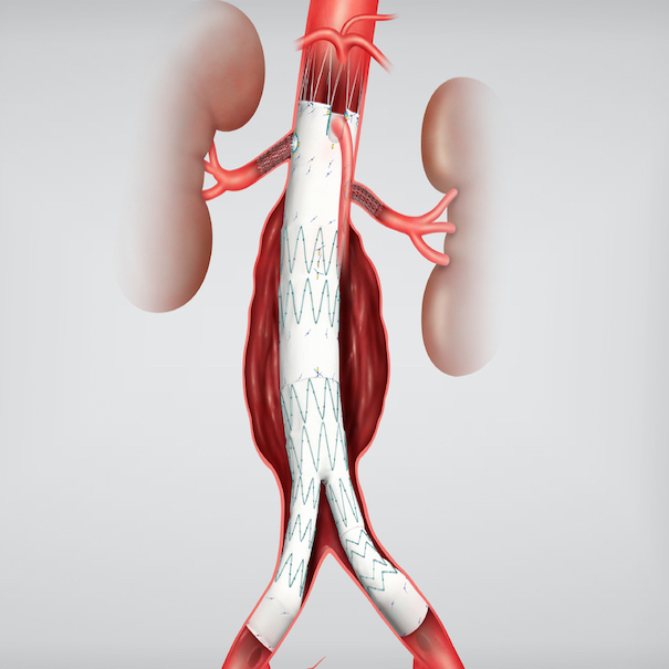 Zenith Fenestrated Aaa Endovascular Graft Distal Bifurcated Body, 1 Each