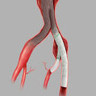 Zenith Branch Endovascular Graft Iliac Bifurcation, 1 Each