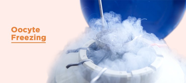 Oocyte Freezing Kit, 1 Kit