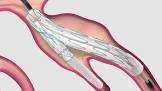 Zenith Helical Branch Iliac Endovascular Graft Helical Iliac Sidebranch, 1 Each