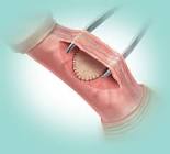 Biodesign Peyronie's Repair Graft, 1 Each