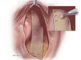 Biodesign Posterior Pelvic Floor Graft, 1 Each