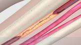 Approach Hydro St Microwire Wire Guide, 1 Each