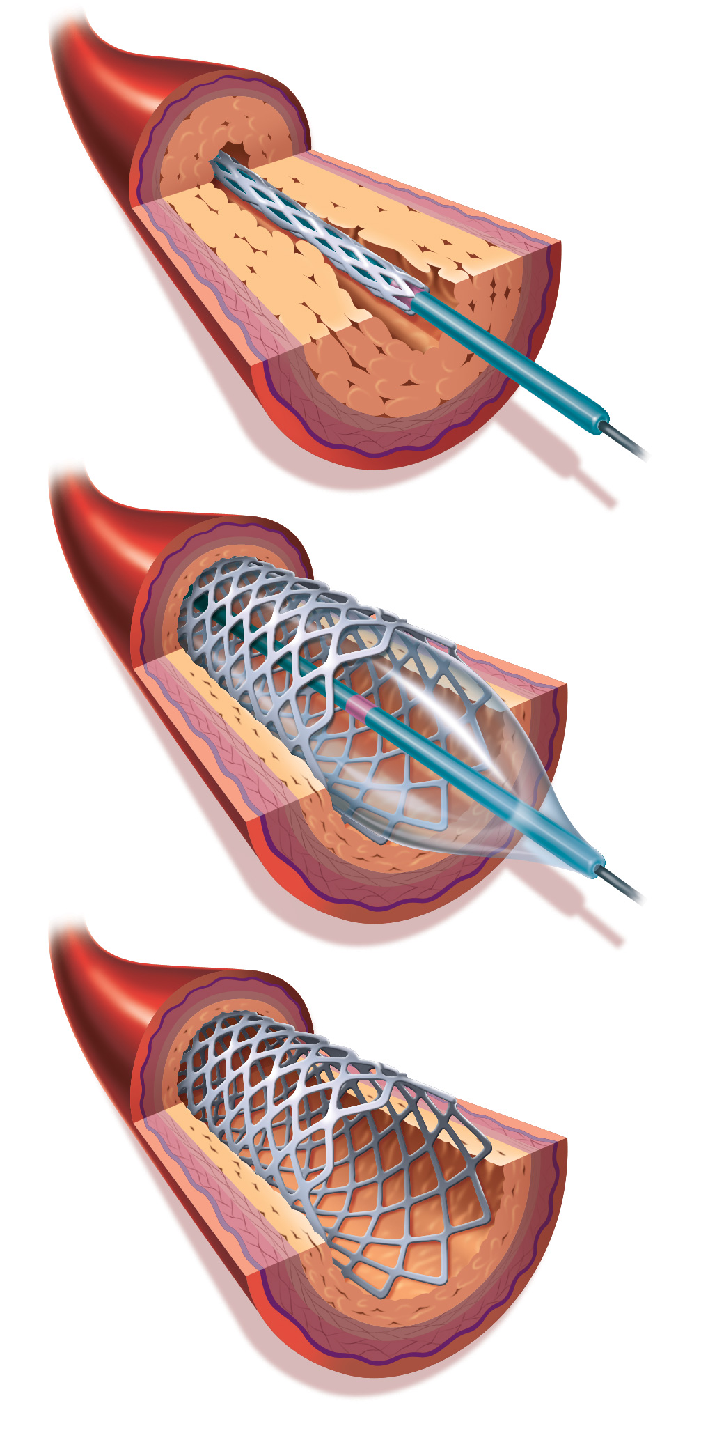 Stent Positioner, 1 Each